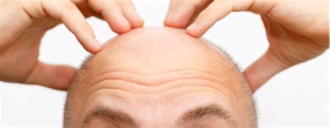 Het Juiste Haartransplantatie Schema Voor Jou